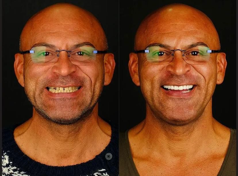 Dental aesthetics result