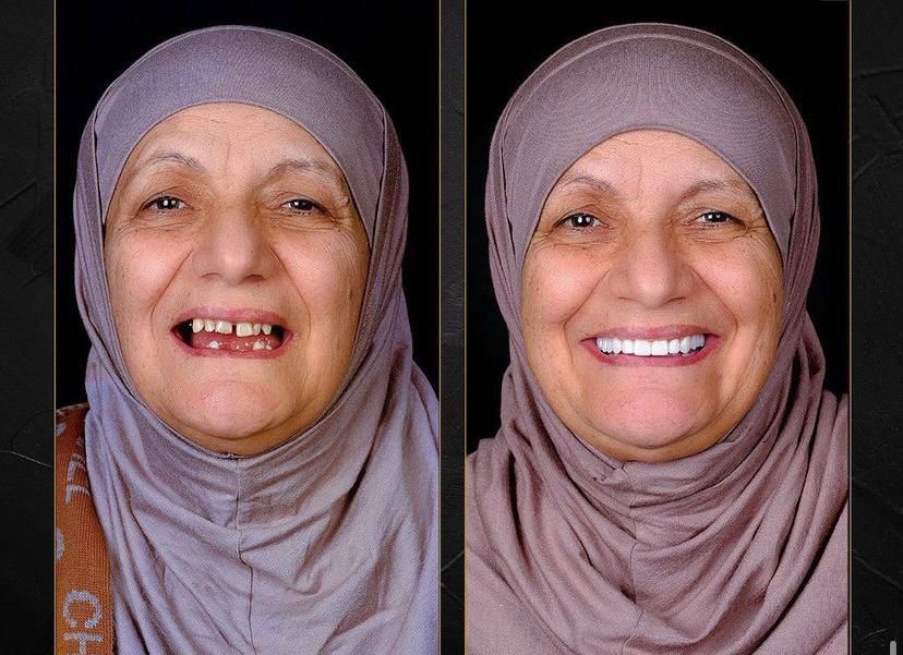 Dental aesthetics result