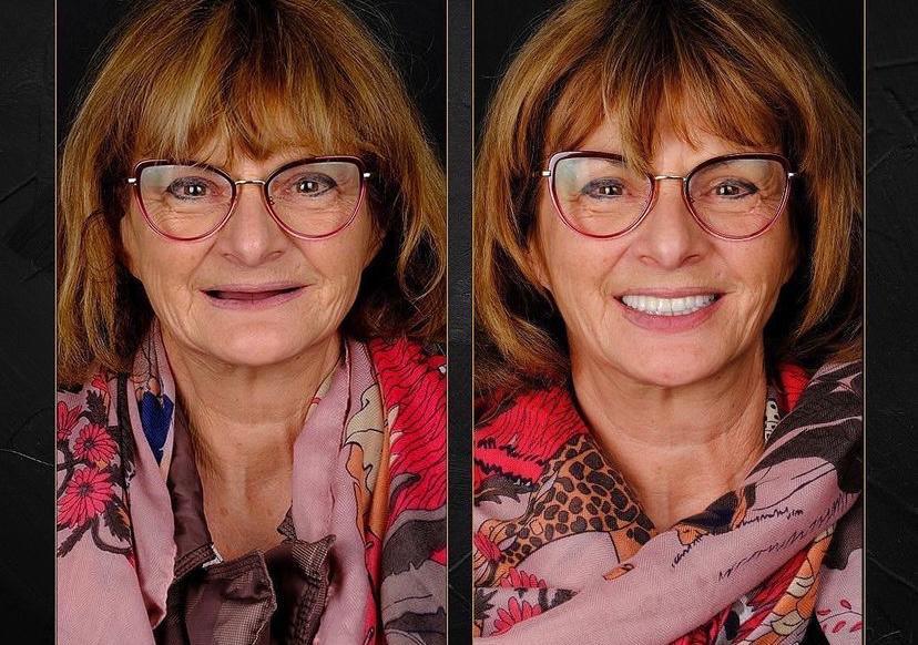 Dental aesthetics result