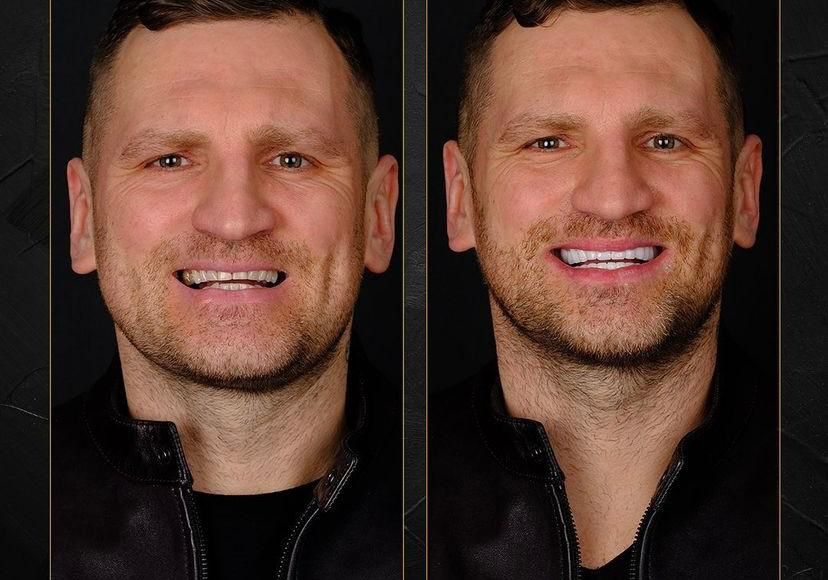 Dental aesthetics result