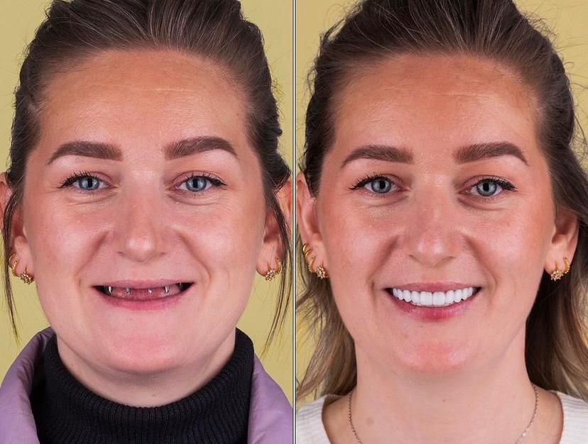 Dental aesthetics result