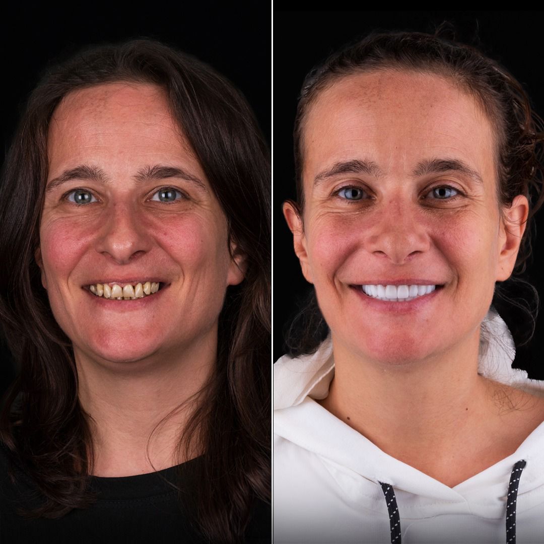 Dental aesthetics result