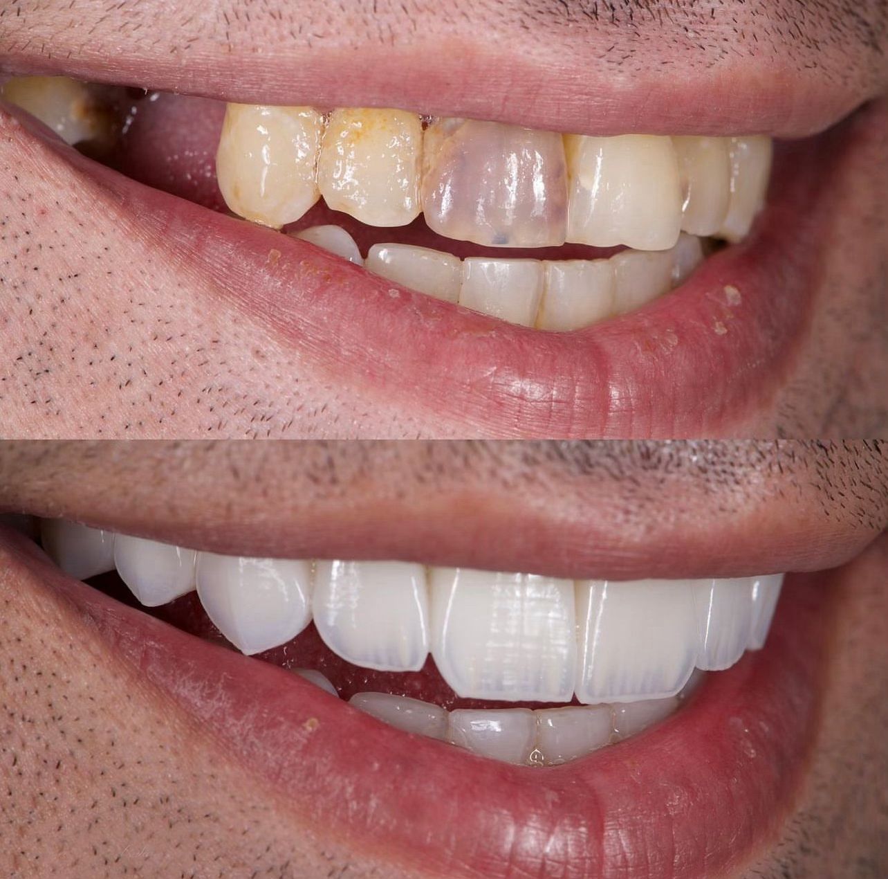 Dental aesthetics result