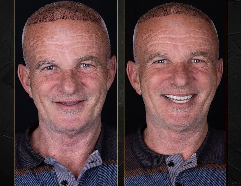 Dental aesthetics result