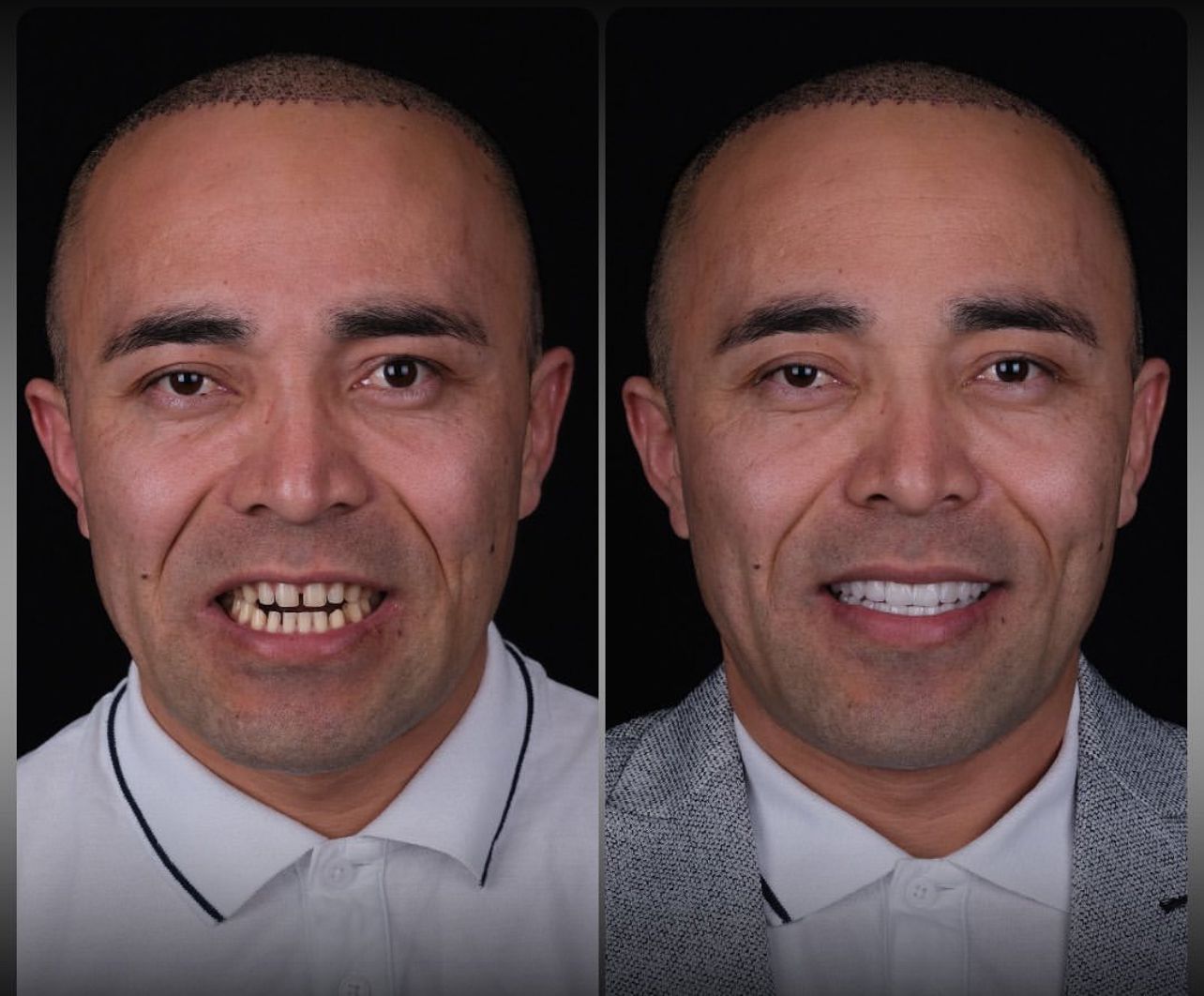Dental aesthetics result