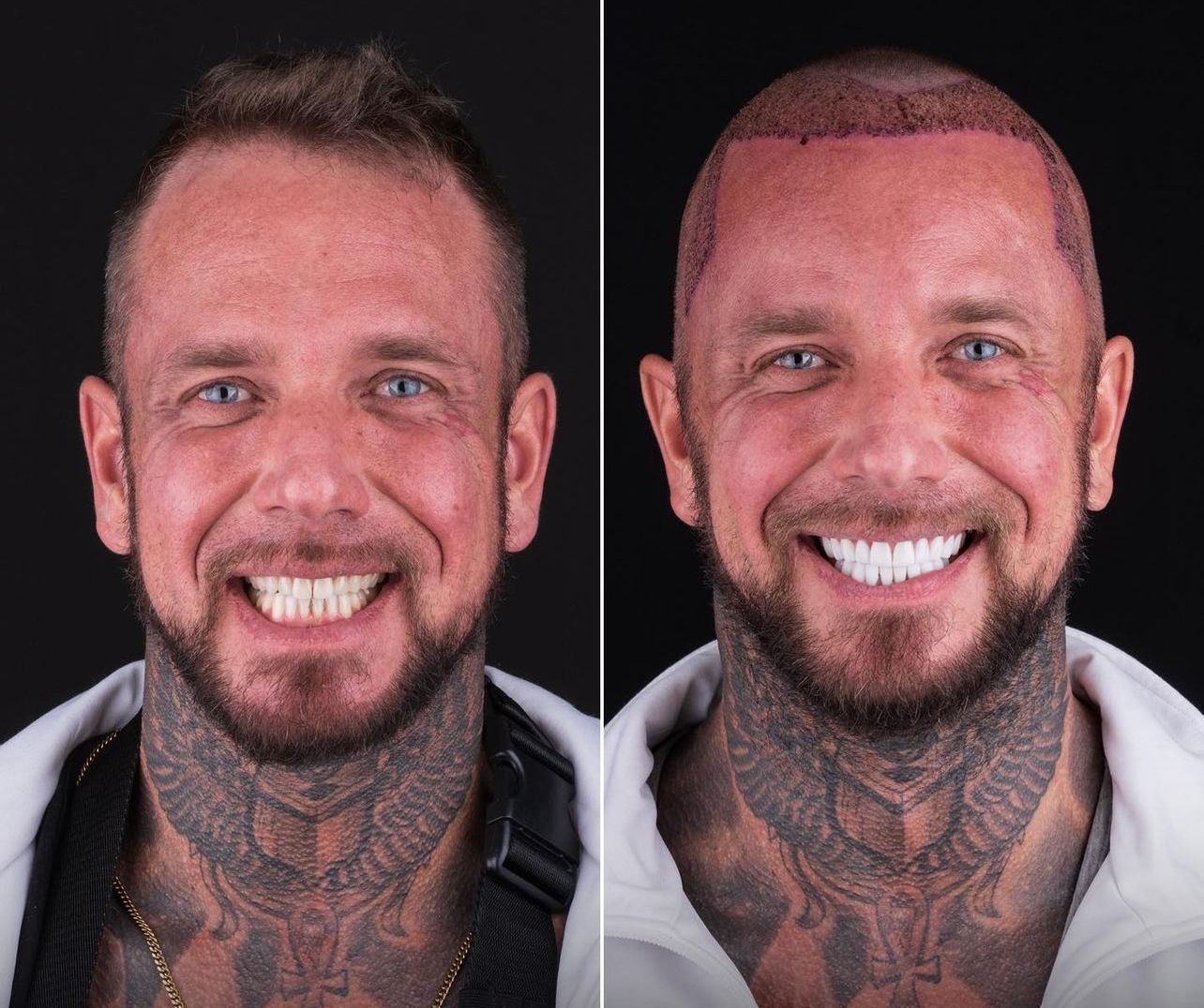 Dental aesthetics result