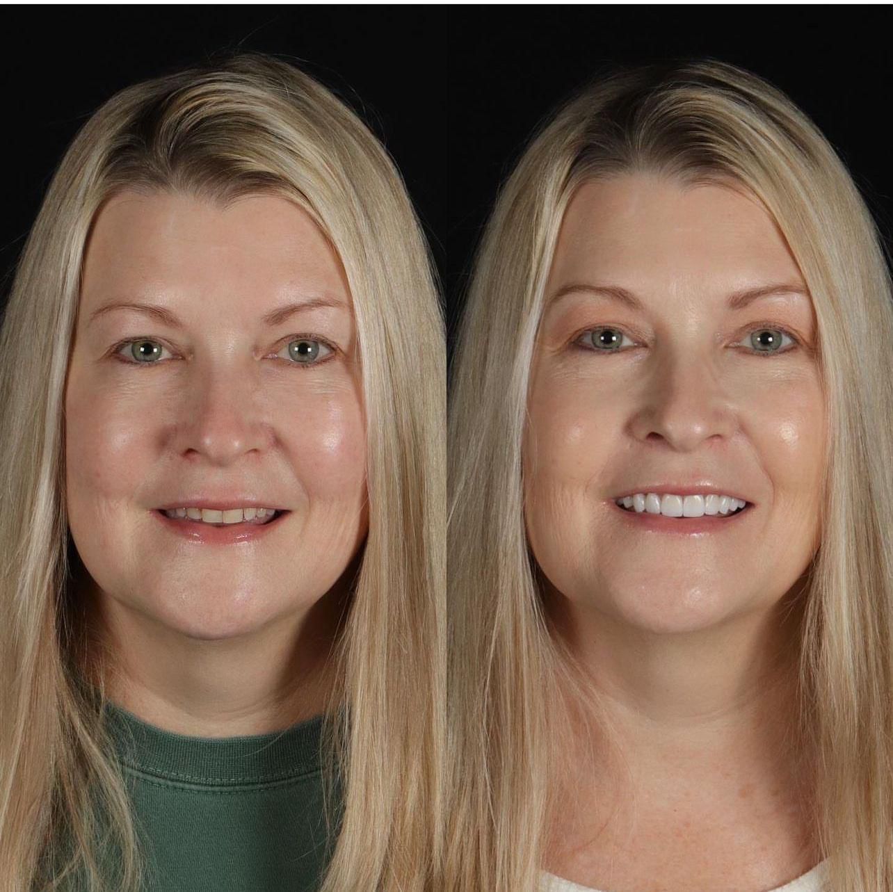 Dental aesthetics result