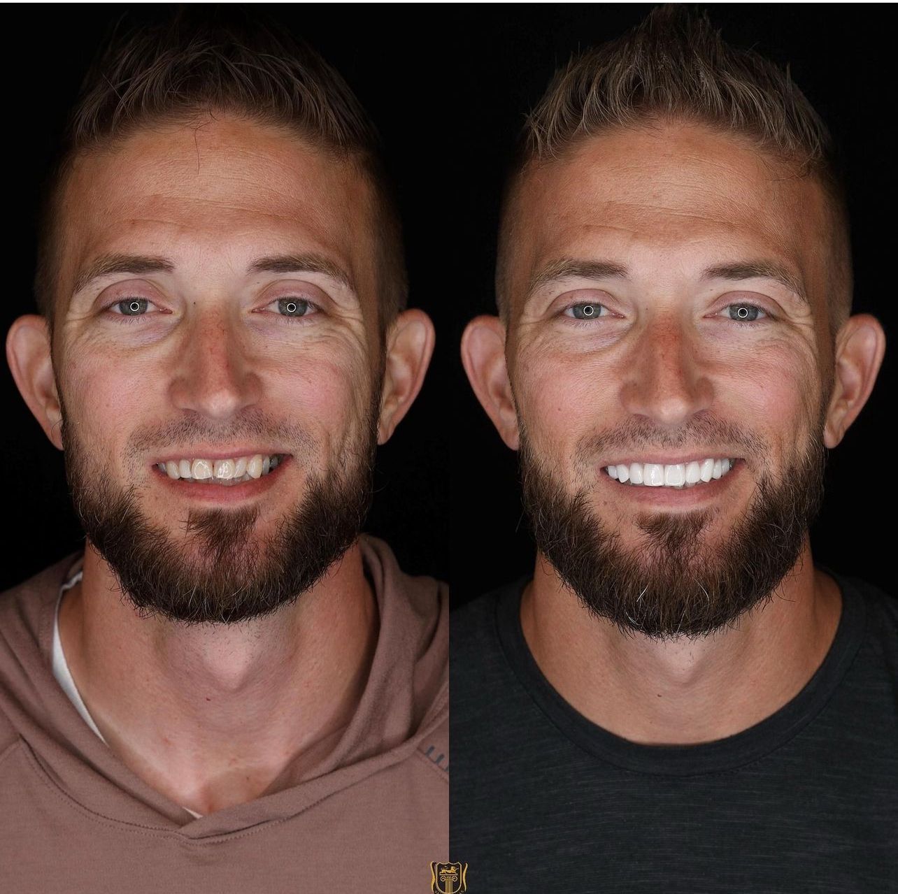 Dental aesthetics result