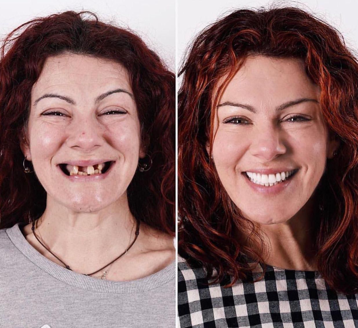 Dental aesthetics result