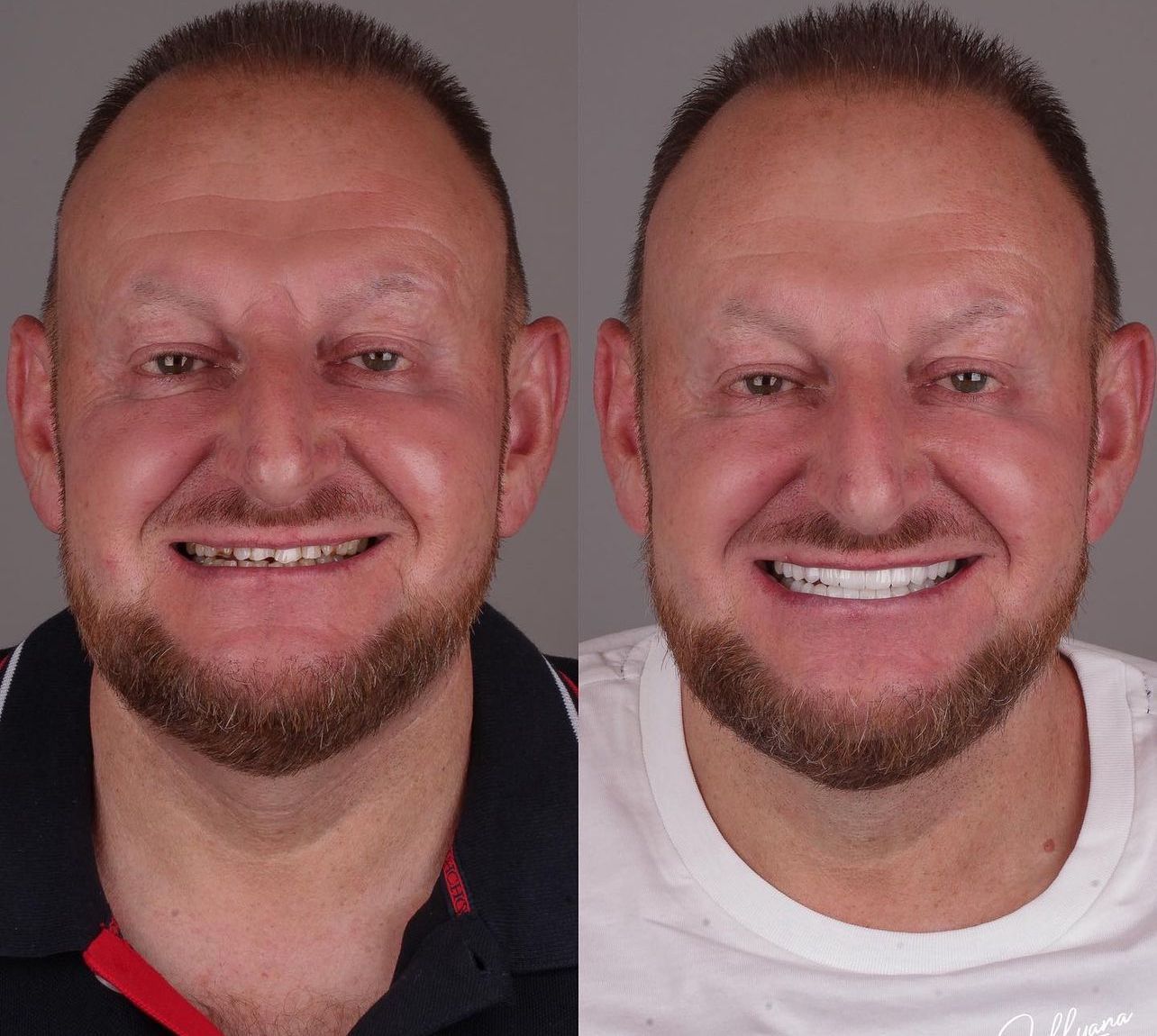 Dental aesthetics result