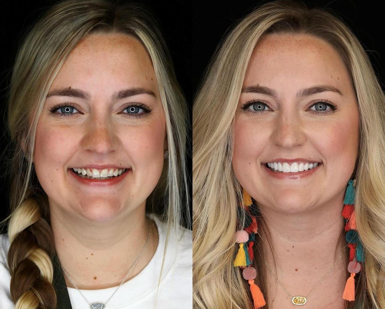 Dental aesthetics result