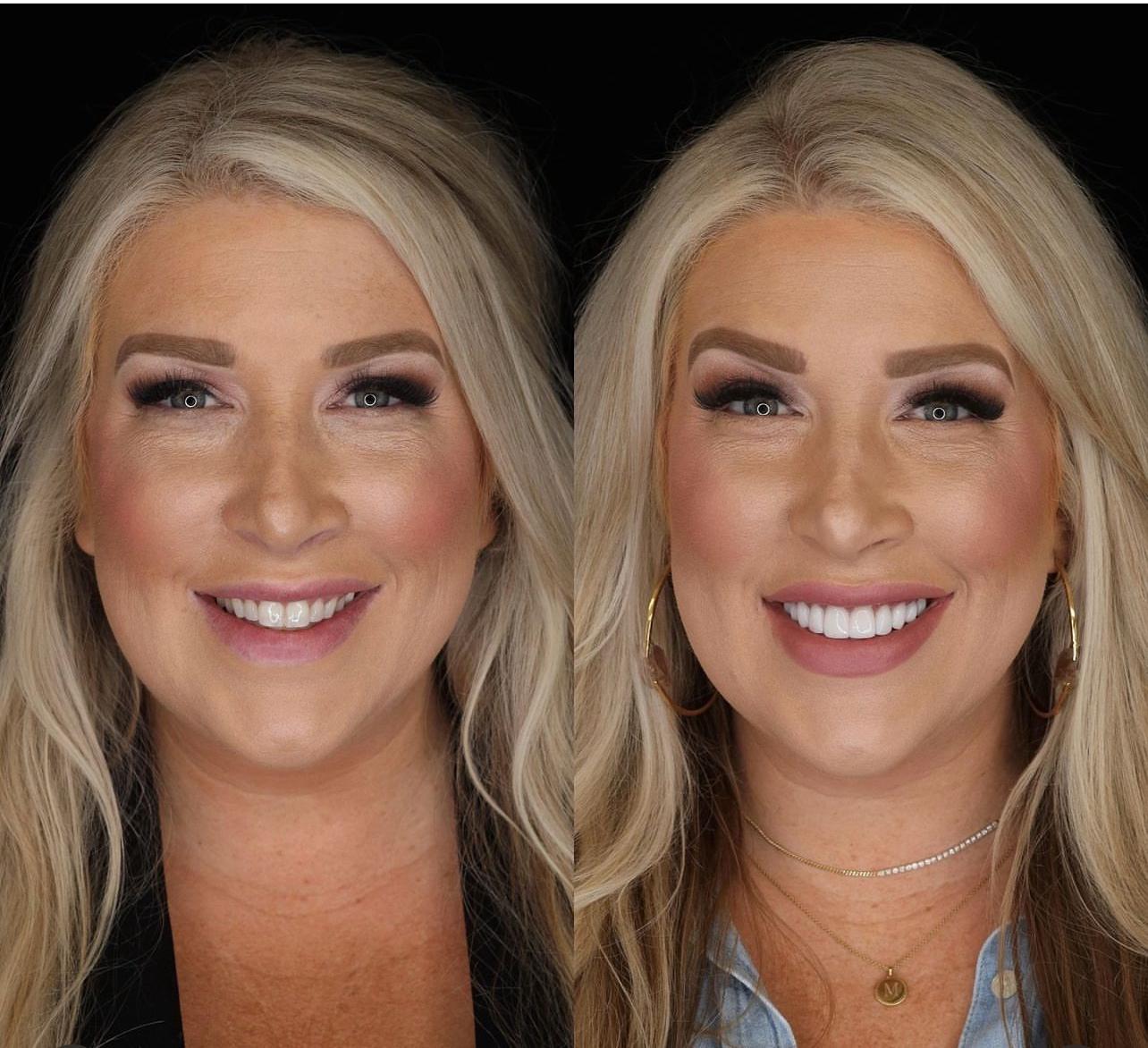 Dental aesthetics result