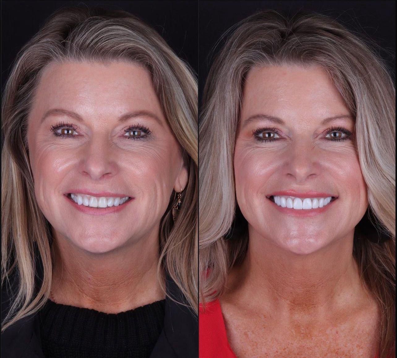 Dental aesthetics result