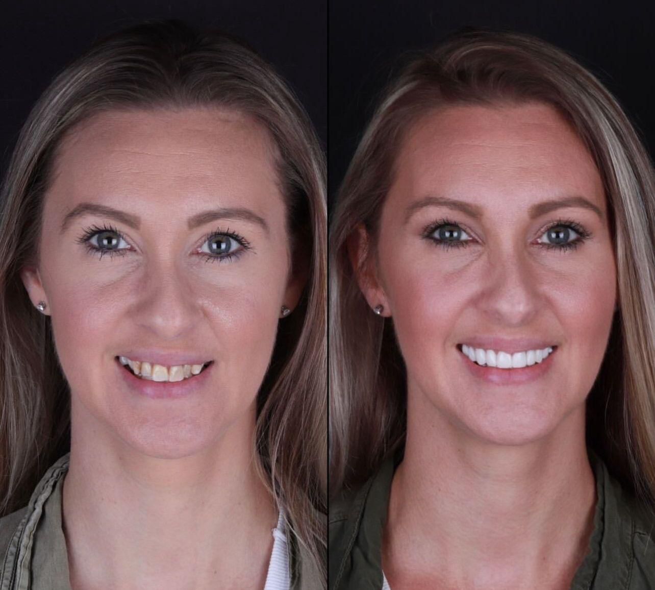 Dental aesthetics result