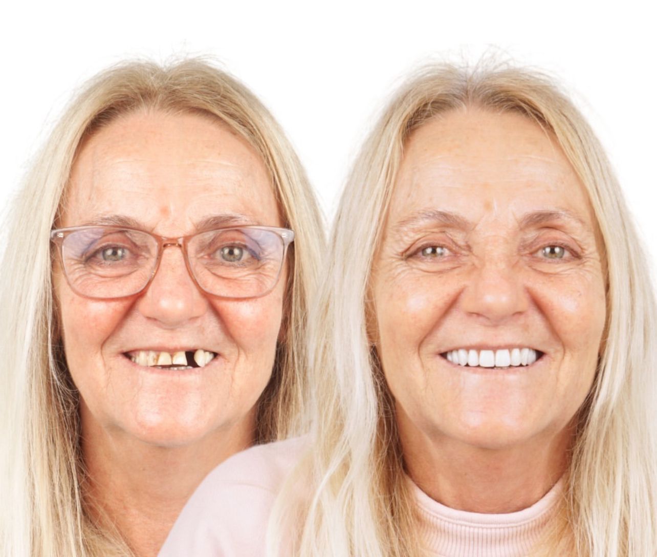 Dental aesthetics result