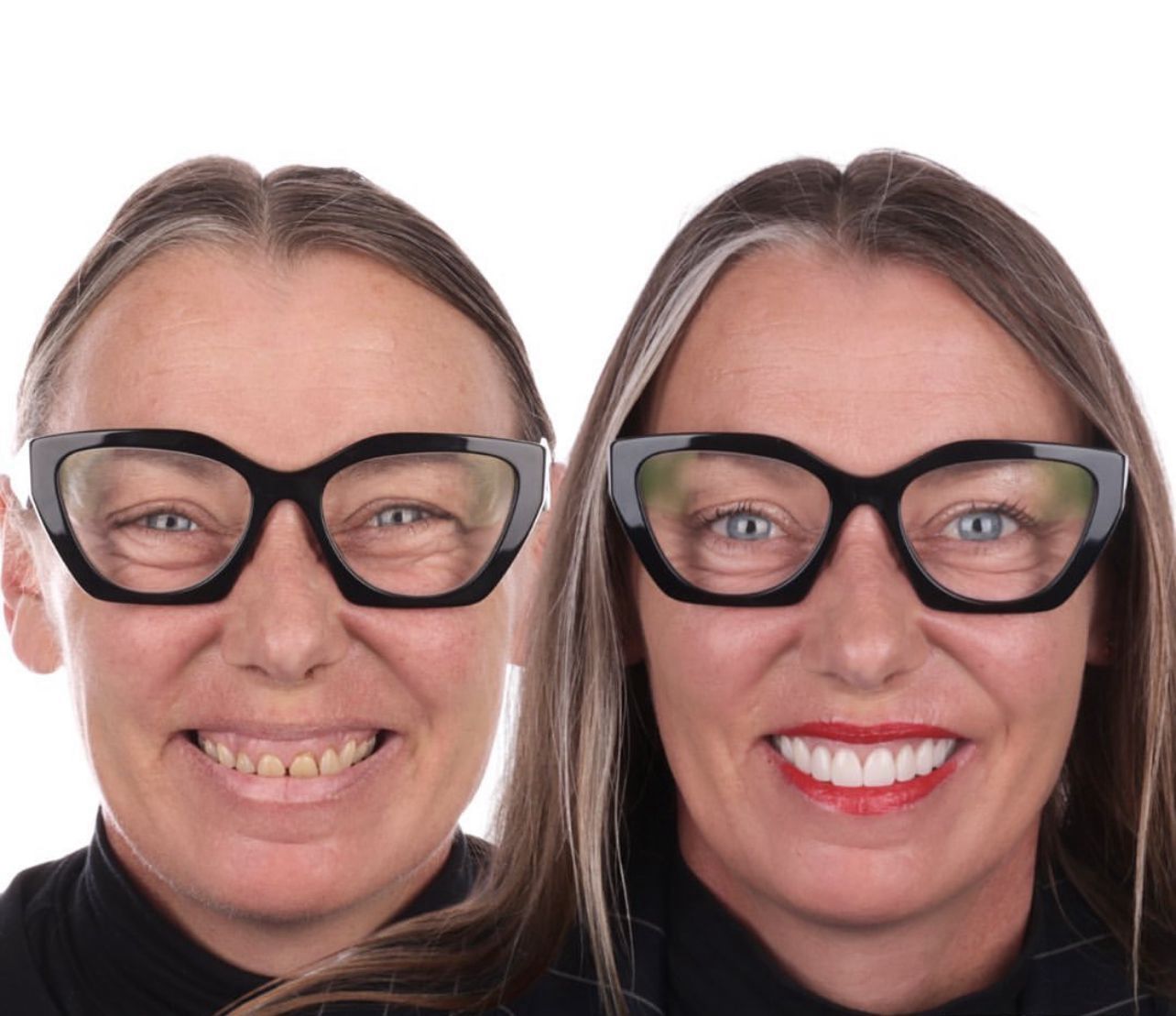 Dental aesthetics result