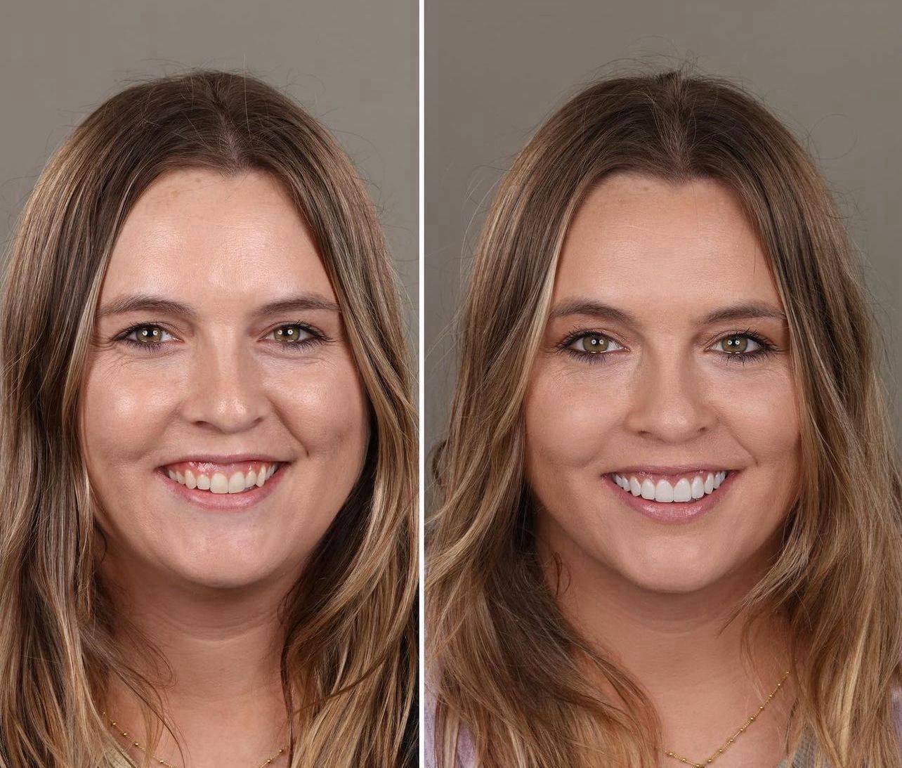 Dental aesthetics result