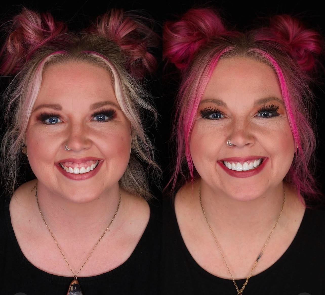 Dental aesthetics result