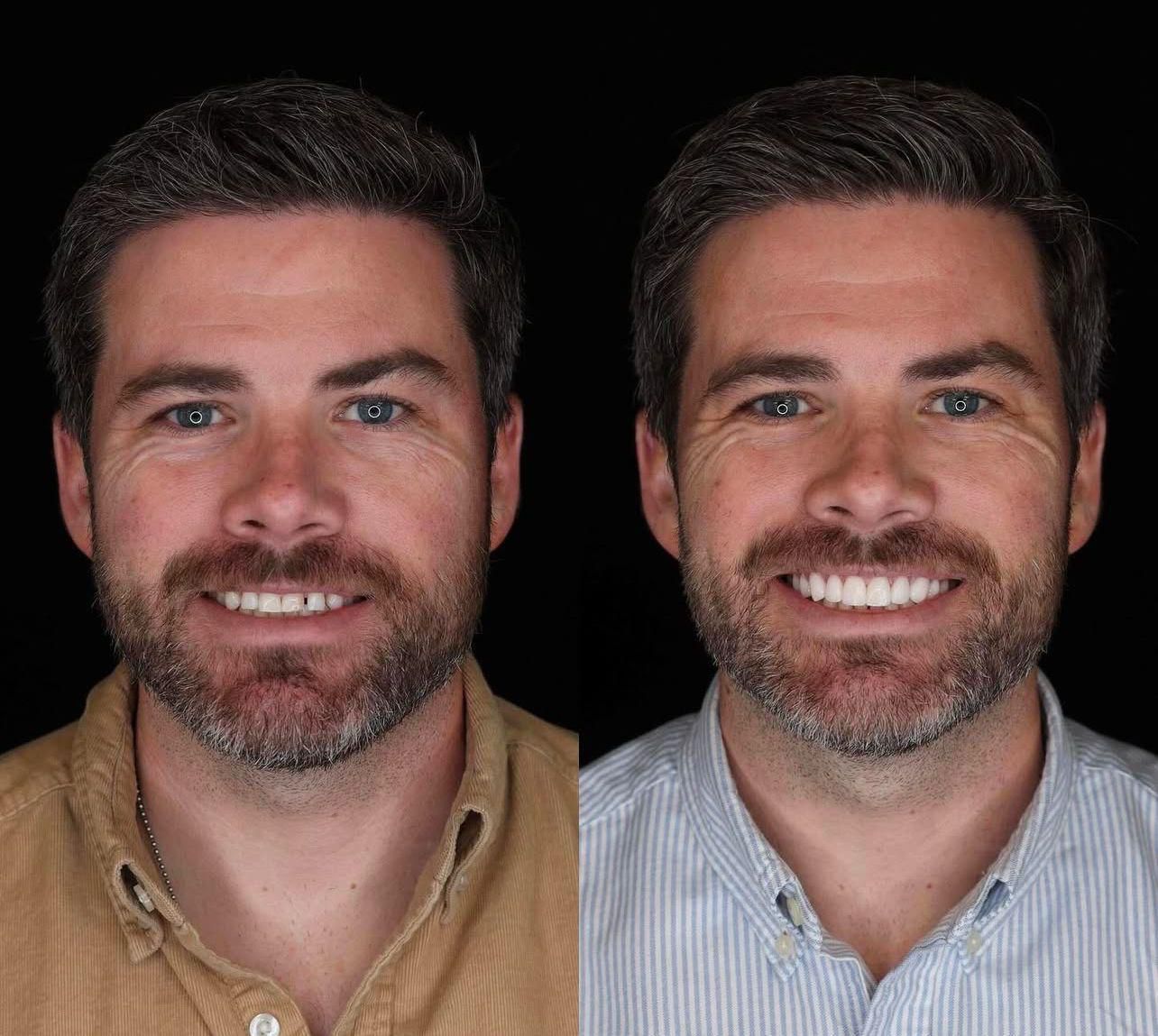 Dental aesthetics result