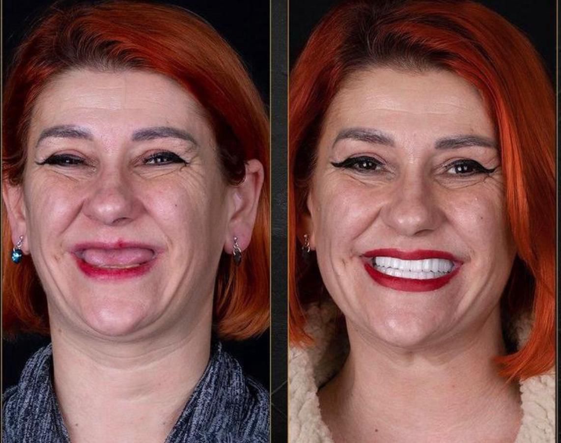 Dental aesthetics result