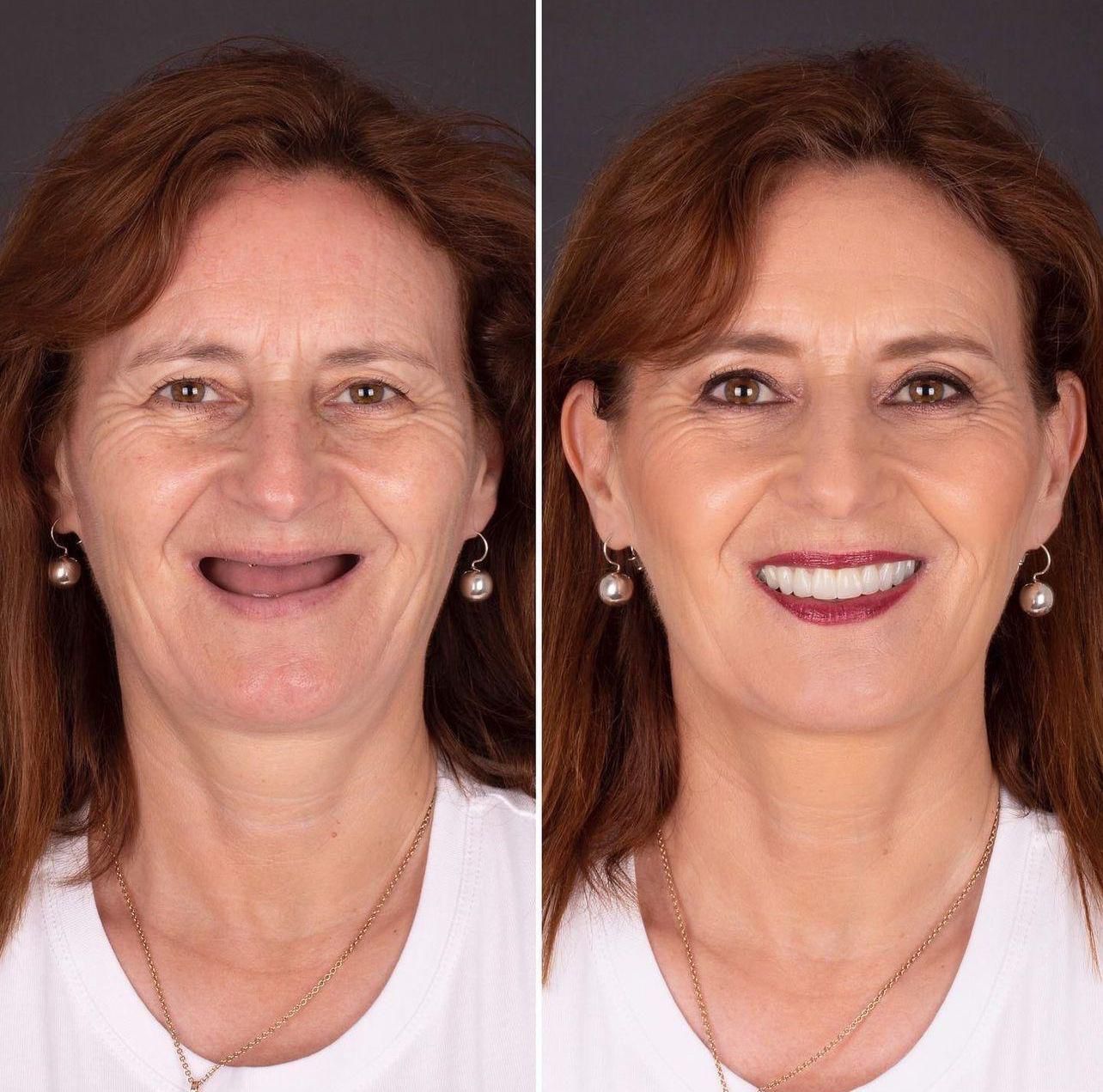 Dental aesthetics result