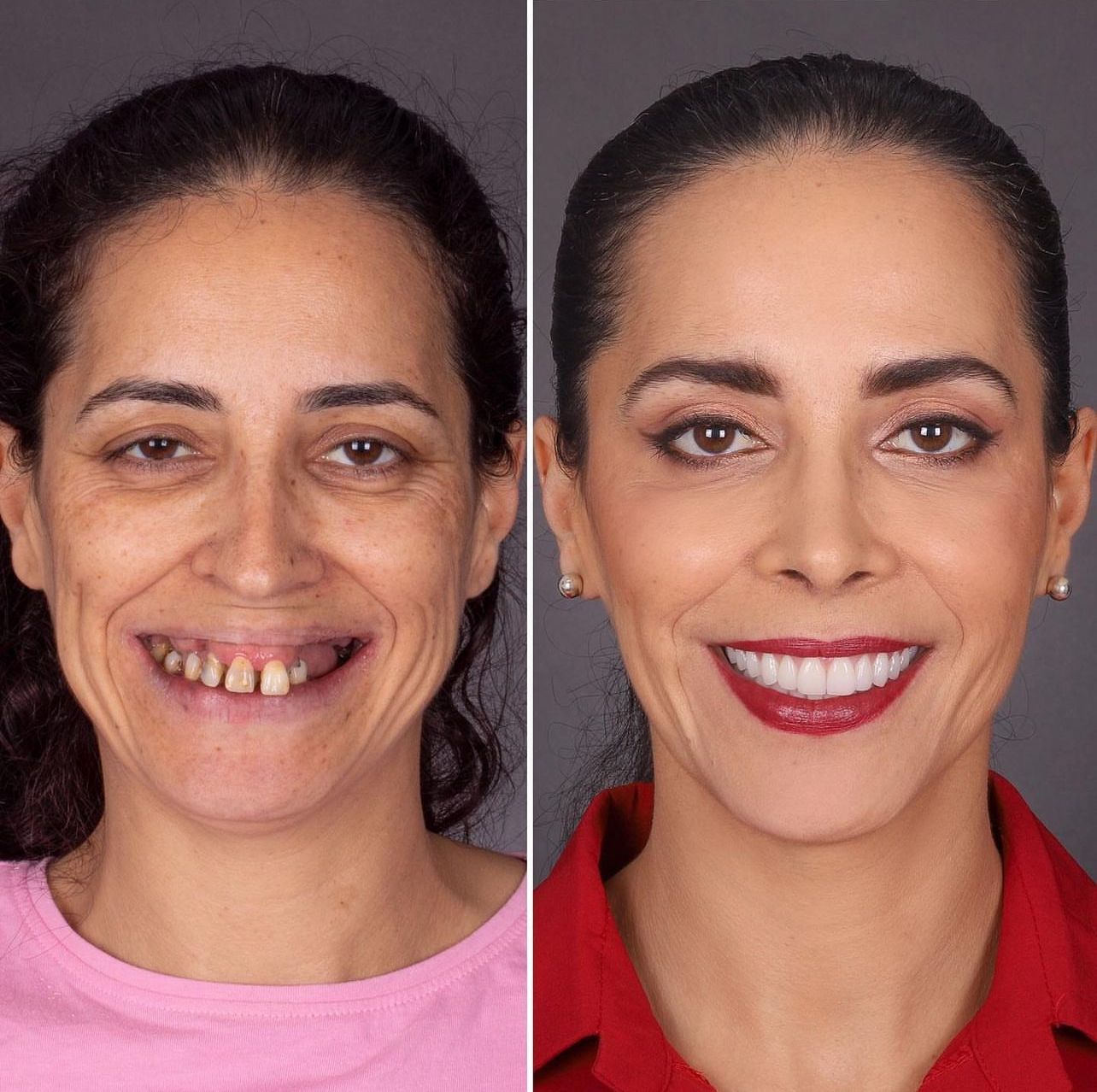 Dental aesthetics result