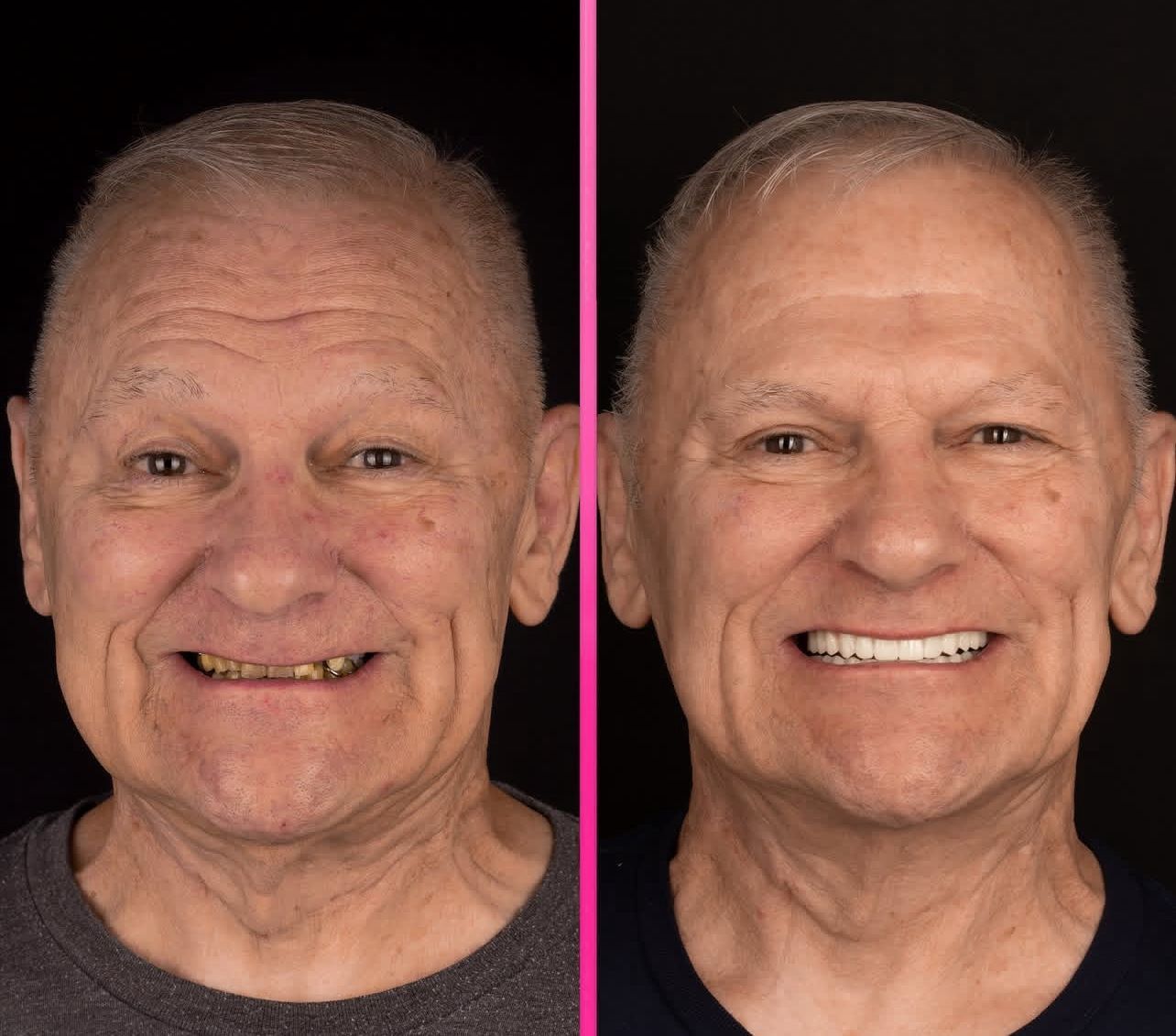 Dental aesthetics result