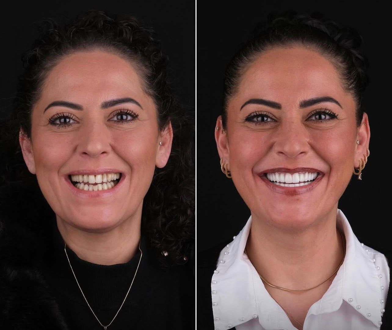Dental aesthetics result