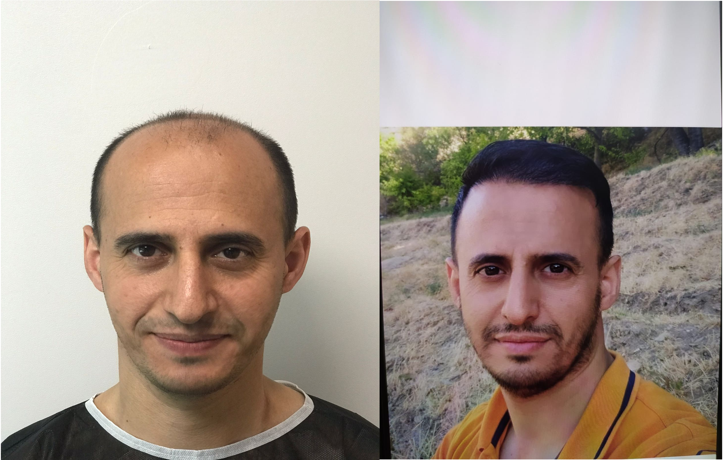 Hair transplant result