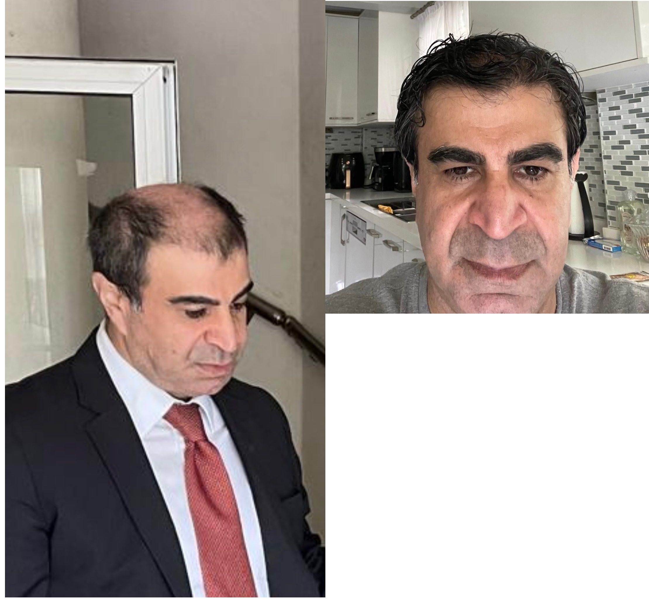 Hair transplant result