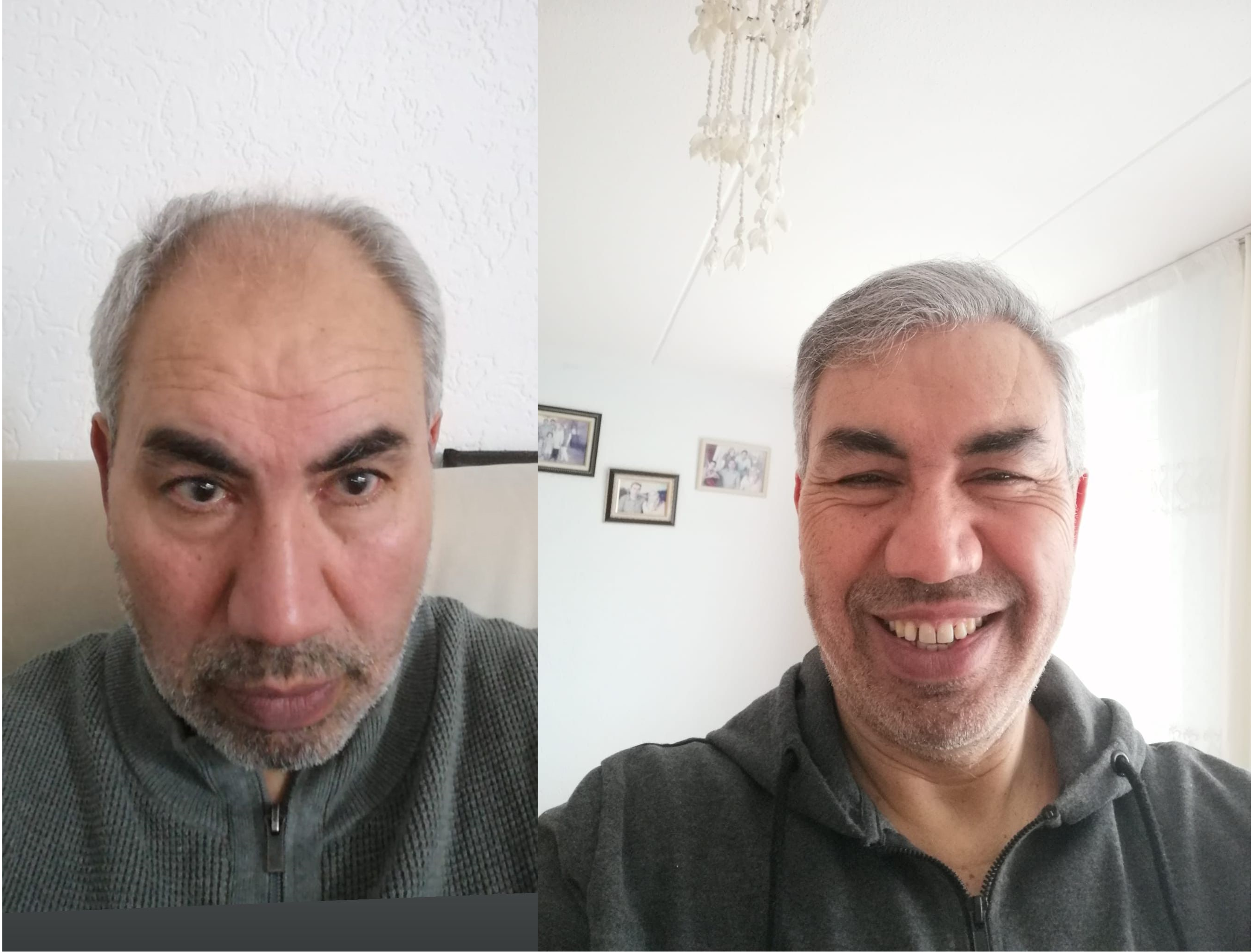 Hair transplant result