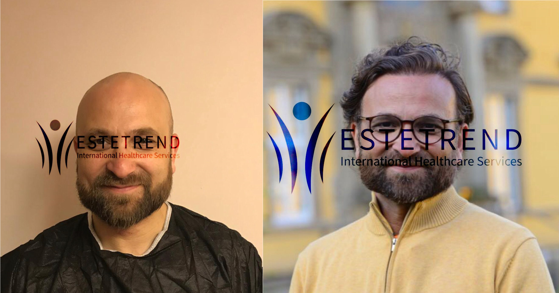 Hair transplant result