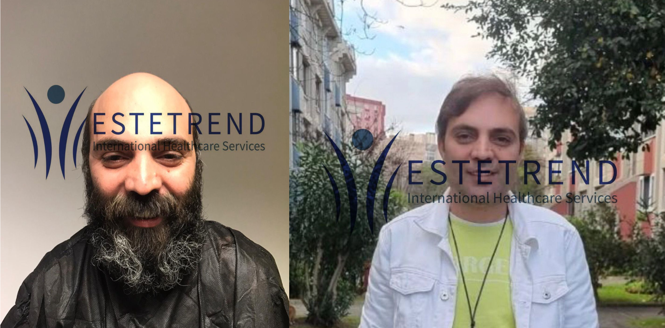 Hair transplant result