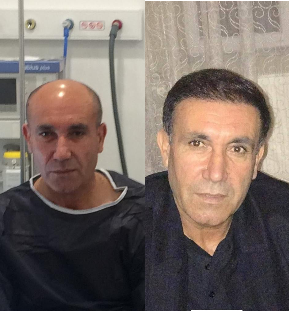 Hair transplant result