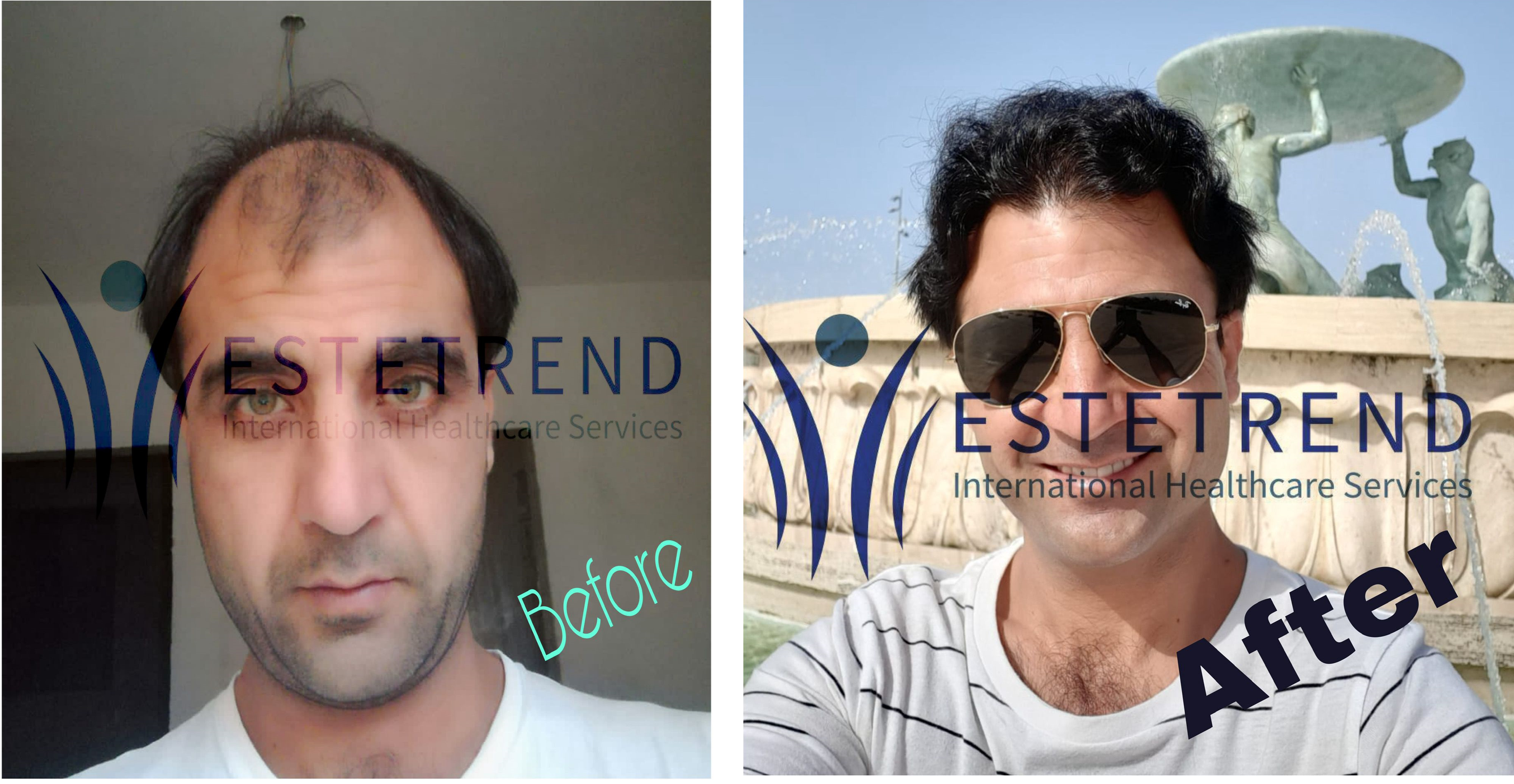 Hair transplant result