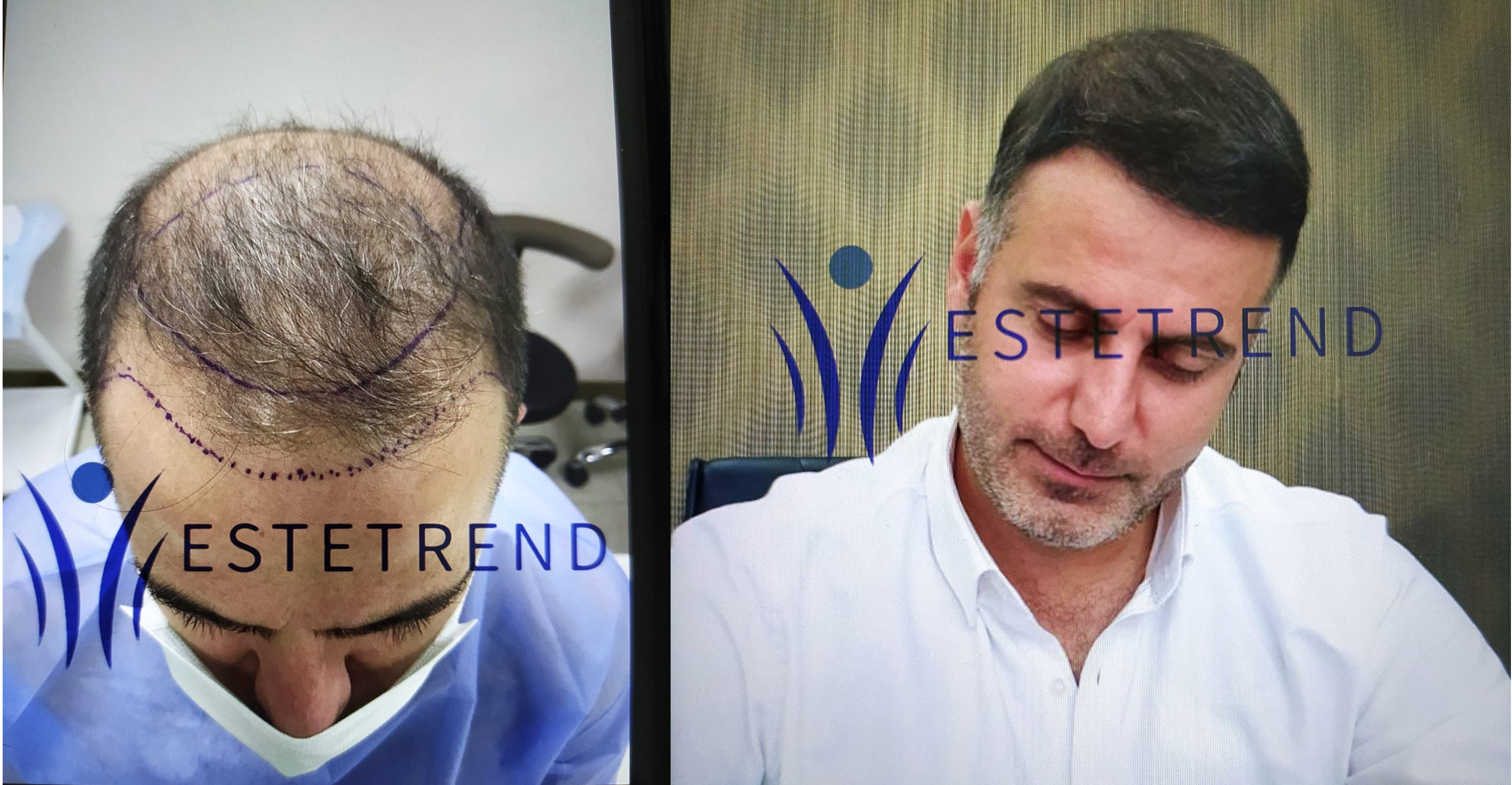 Hair transplant result
