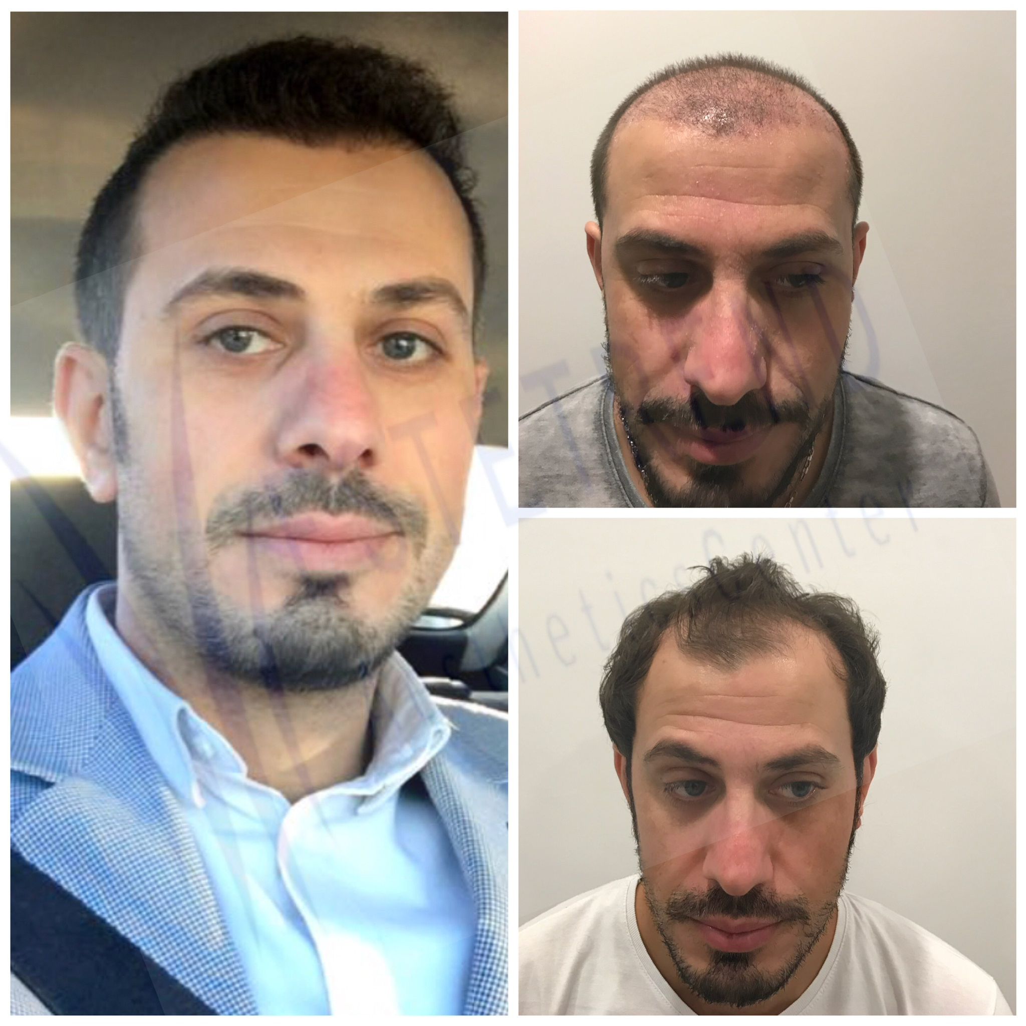 Hair transplant result