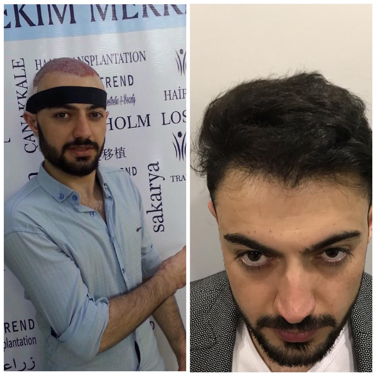 Hair transplant result