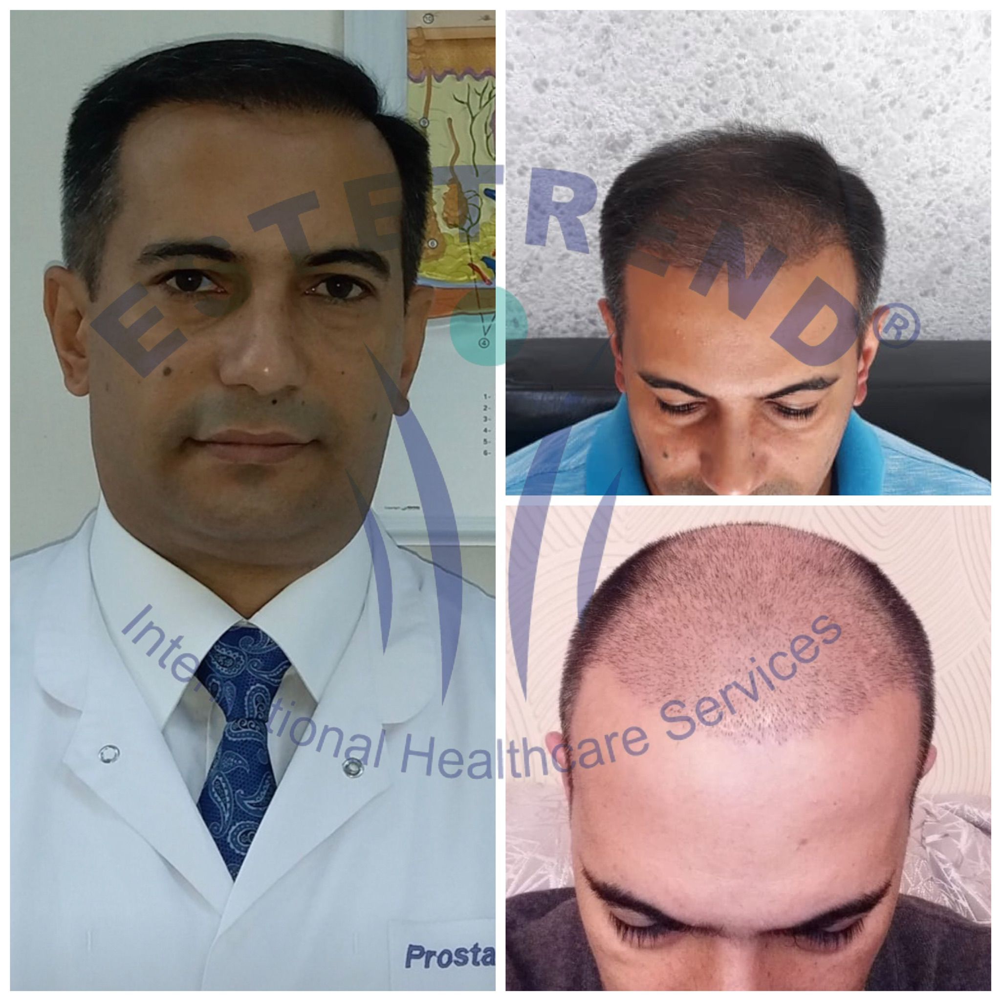 Hair transplant result