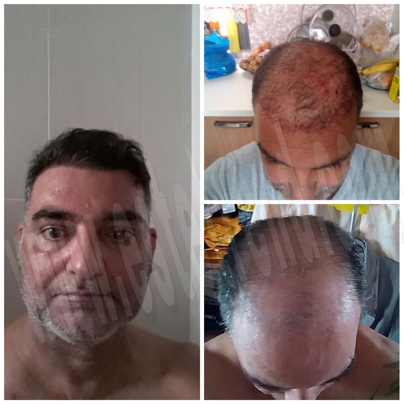 Hair transplant result