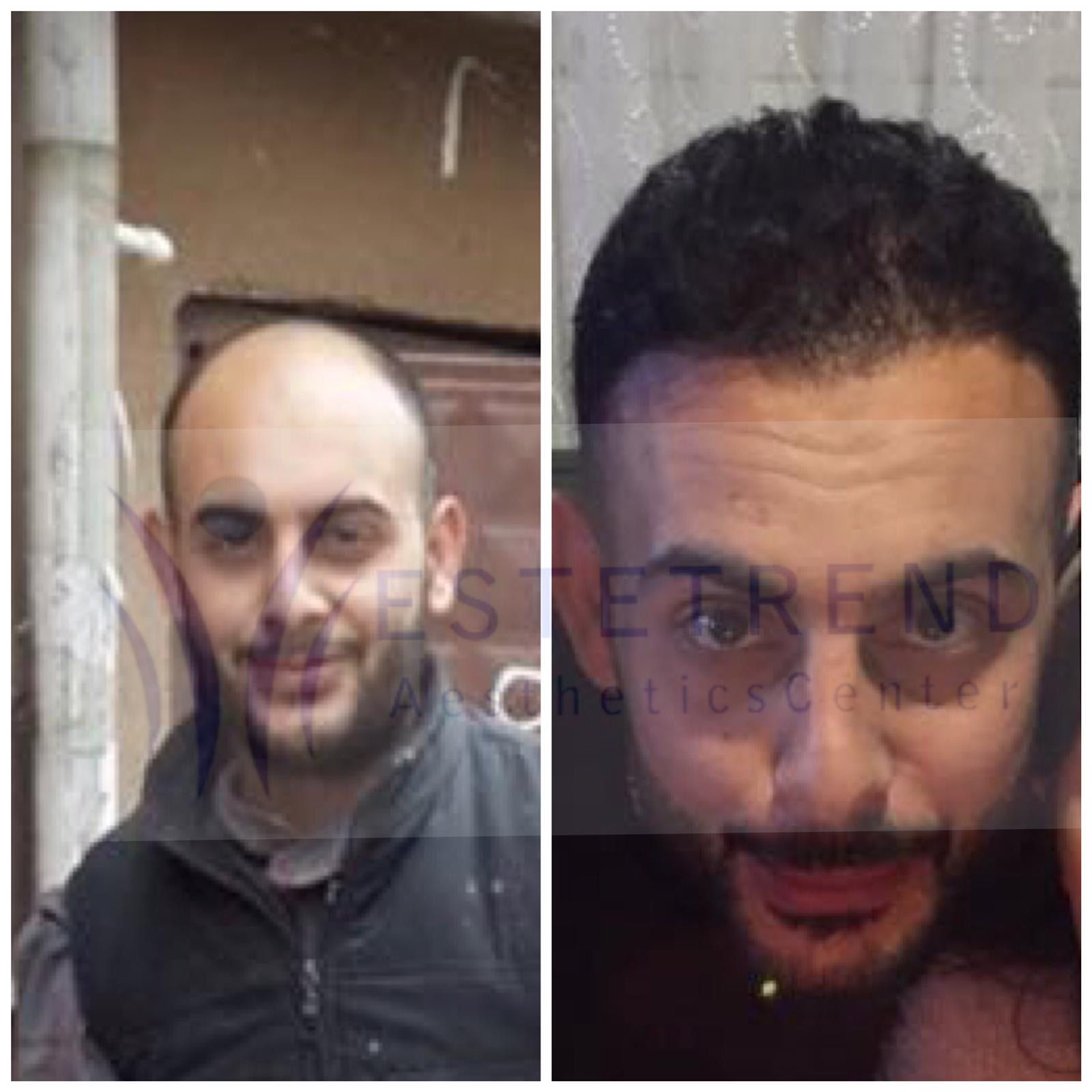 Hair transplant result