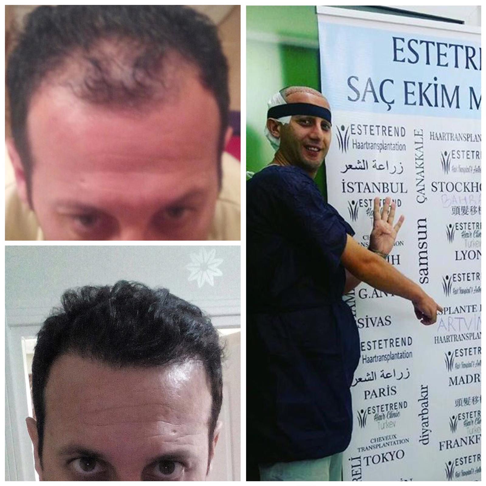 Hair transplant result