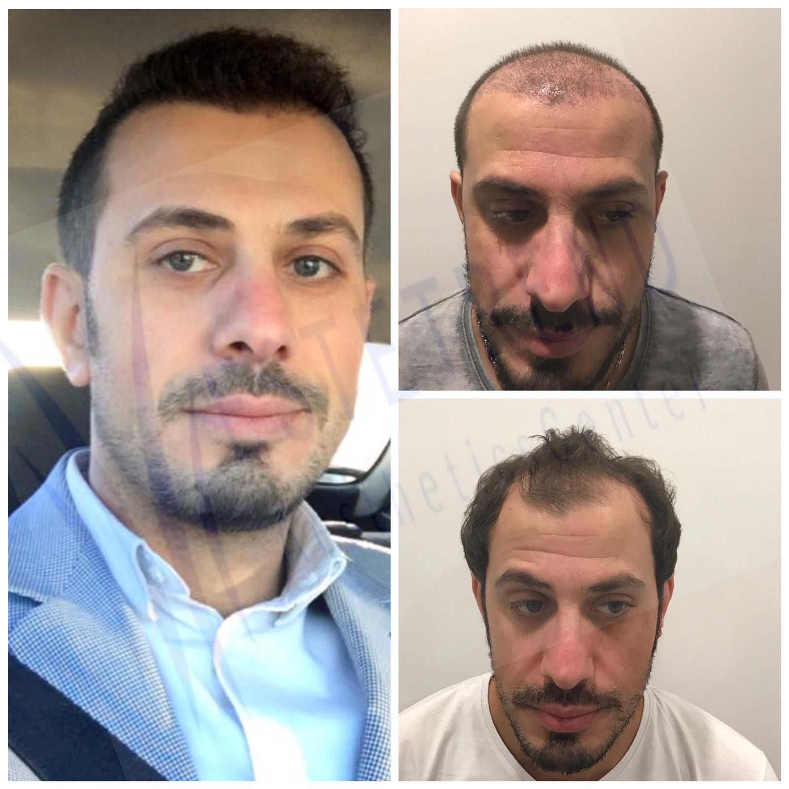 Hair transplant result