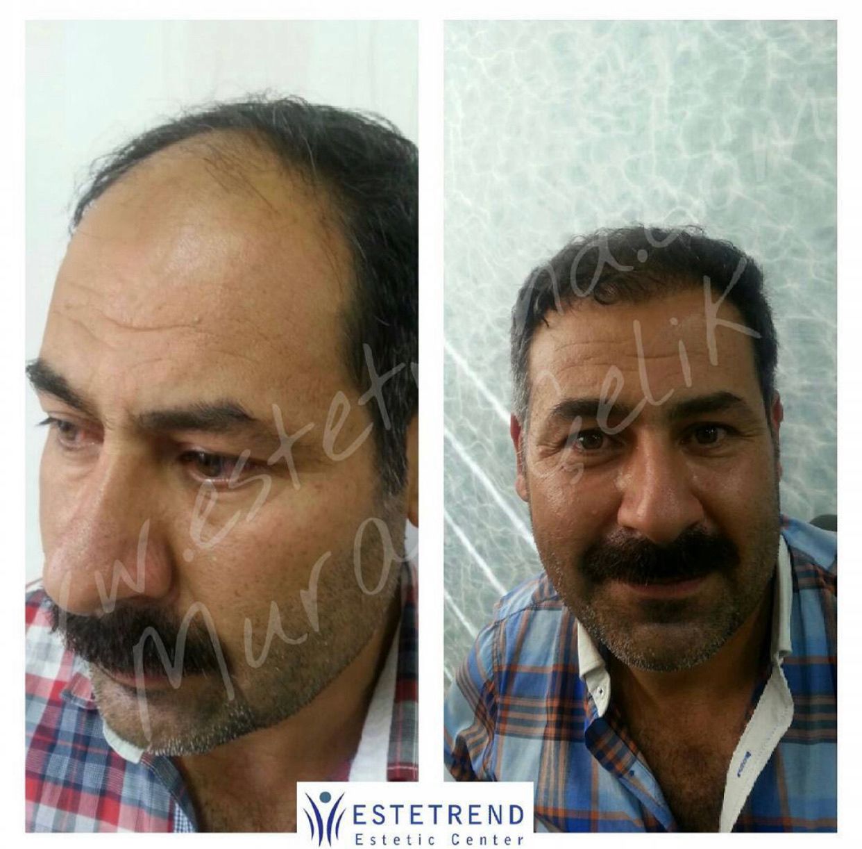 Hair transplant result