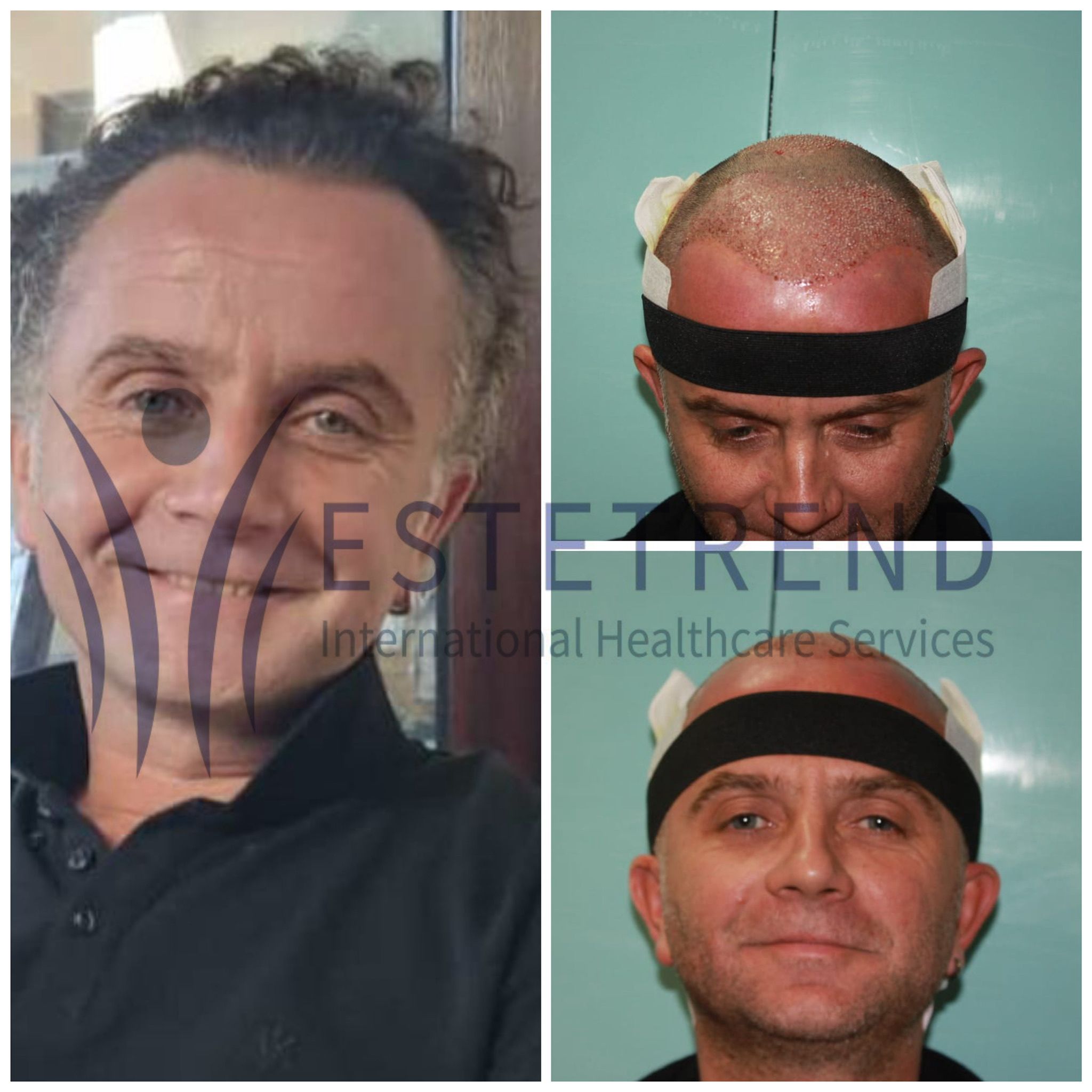 Hair transplant result